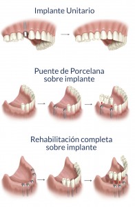 implantes-clinica-dental